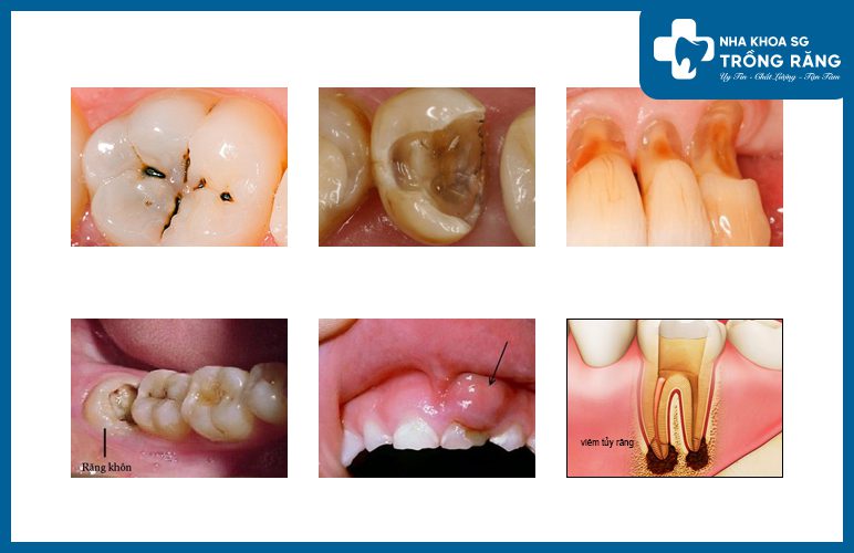 Nguyên gân gây đau nhức răng