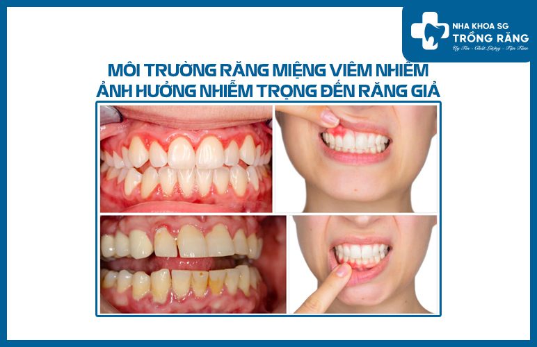 Nguyên nhân răng giả bị đau nhức