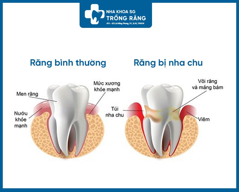 Như thế nào là viêm nha chu