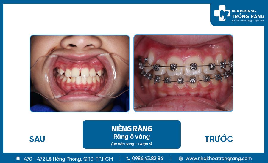 Niềng răng thưa của bé Bảo Long