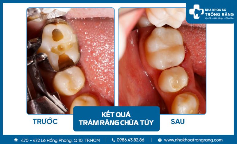 Quy trình Trám răng sâu chữa tủy