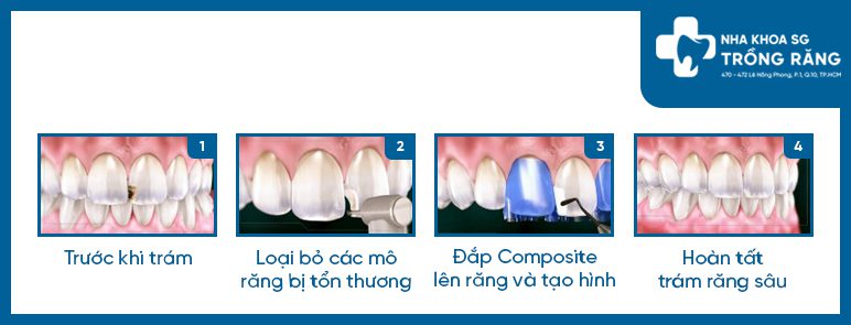 Quy trình trám răng cửa sâu