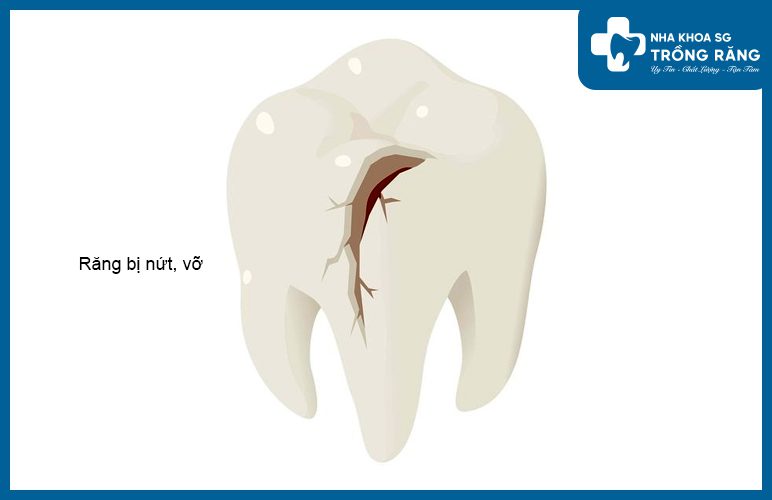 Răng bị nứt