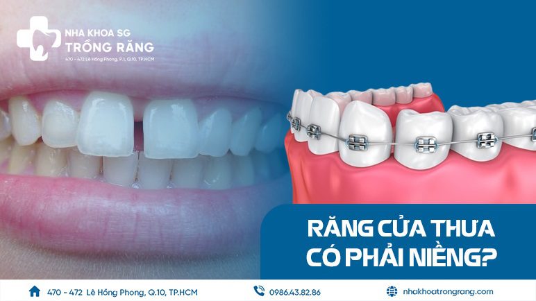 Răng cửa bị thưa có cần phải niềng