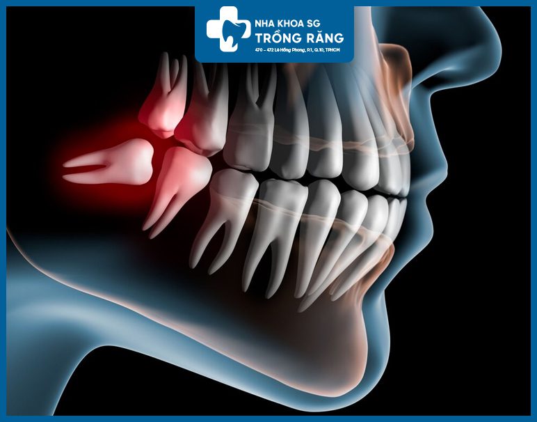 Răng khôn mọc lệch