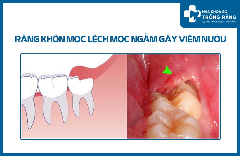 Răng khôn mọc ngầm gây sưng nướu