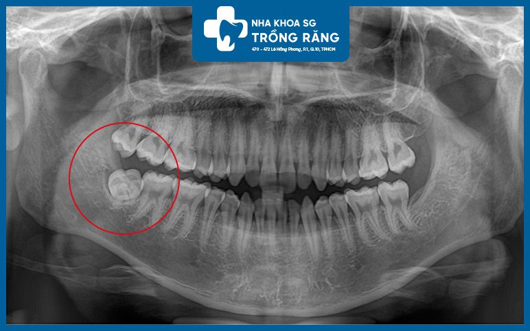 Răng khôn mọc thẳng film xquang