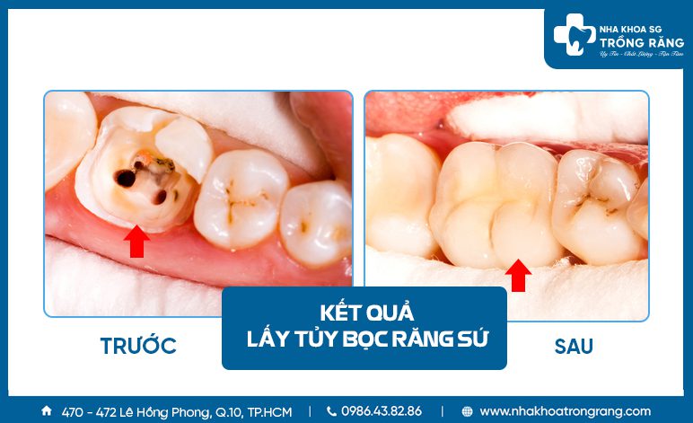 Răng sâu viêm tủy phải bọc sứ