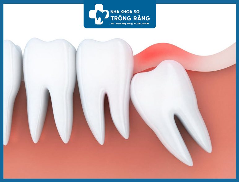 Sưng lợi khi mọc răng khôn