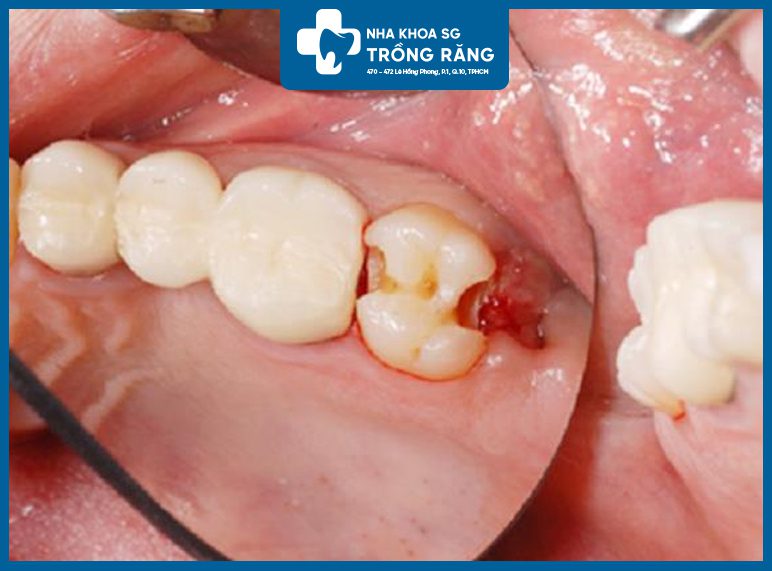 Tác hại của mọc răng khôn làm sâu răng kế bên