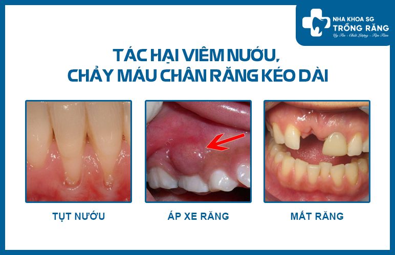 Tác hại của viêm nướu