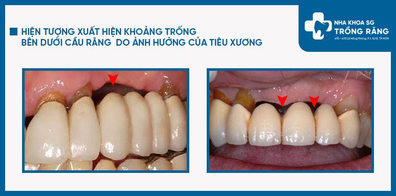 Tiêu xương hàm khi làm cầu răng sứ