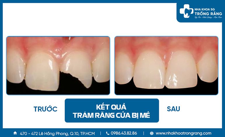 Trám răng bị mẻ nhiều