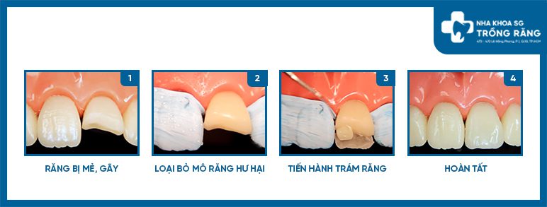 Trám răng cửa bị mẻ