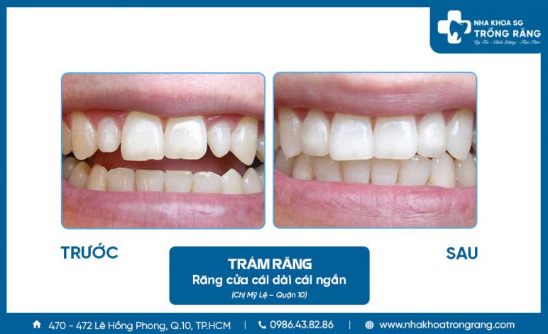 Trám răng cửa cho đều nhau