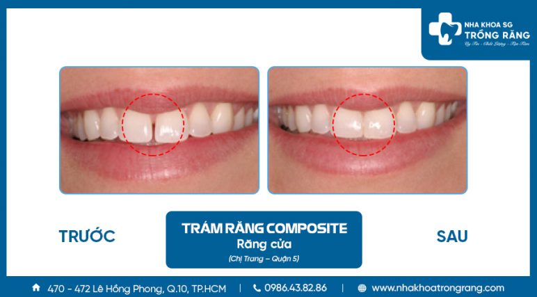 Trám răng cửa thưa