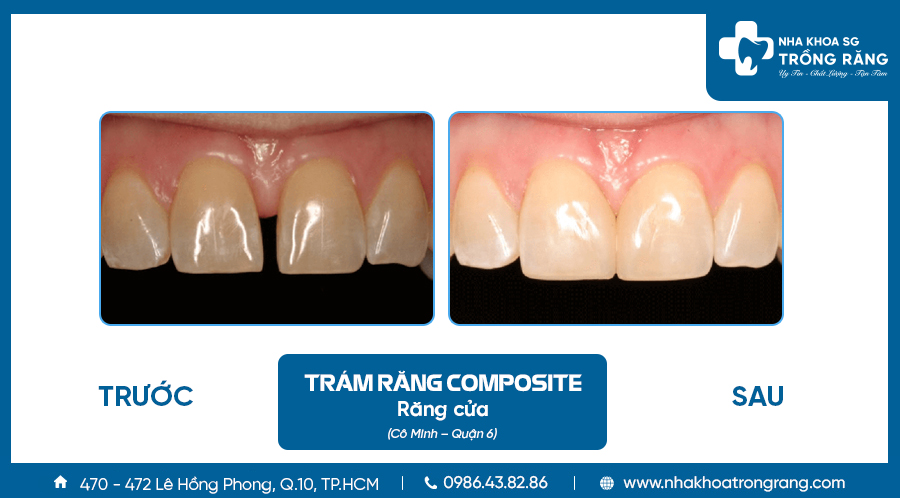Trám răng cửa thưa_Cô Minh