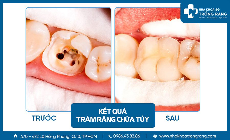 Trám răng sâu chữa tủy răng số 6