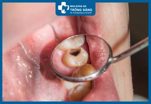 Trám răng sâu lấy tủy giá bao nhiêu