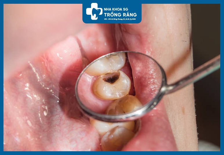 Trám răng sâu lấy tủy giá bao nhiêu