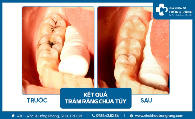 Tram rang sau rang nhai e1627700506273 Trám răng sâu, trám răng thẩm mỹ - Ưu đãi lên đến【-50%】chi phí