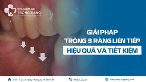 Trồng 3 răng liên tiếp như thế nào là hiệu quả tiết kiệm