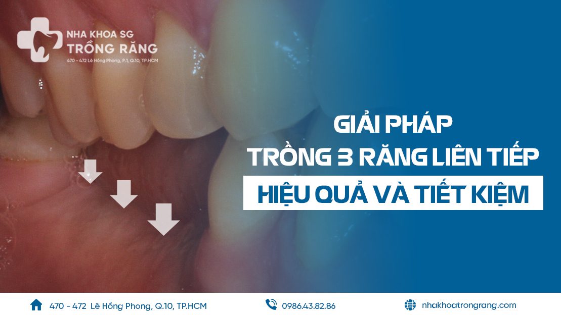 Trồng 3 răng liên tiếp như thế nào là hiệu quả tiết kiệm