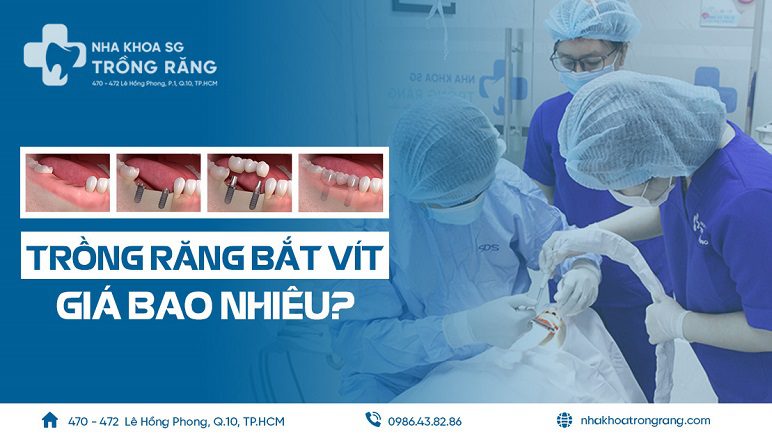 Trồng răng bắt vít giá bao nhiêu