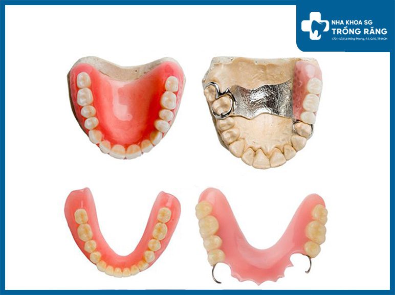 Các loại răng giả tháo lắp