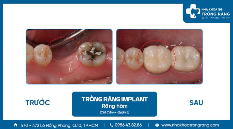 Trồng răng hàm số 6 bằng cấy ghép implant