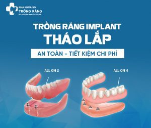 Trồng răng implant tháo lắp