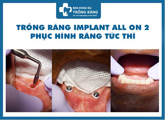 Trồng răng implant tháo lắp all on 2