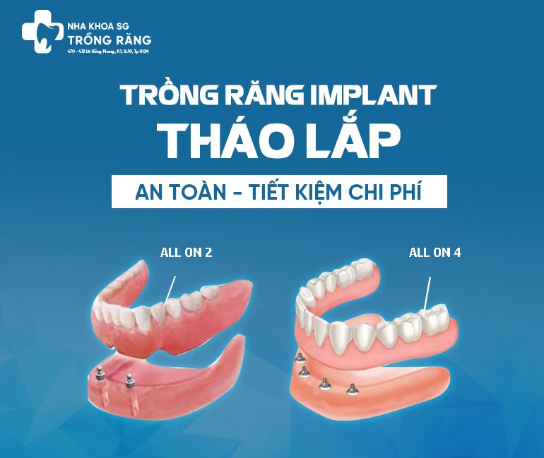 Trồng răng implant tháo lắp