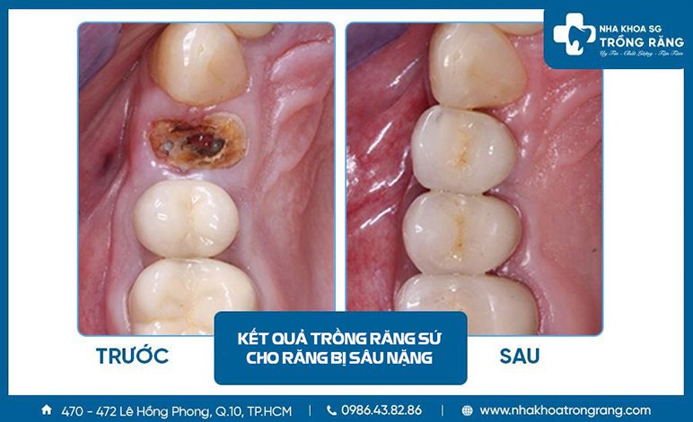 Trồng răng sứ cho răng bị sâu nặng