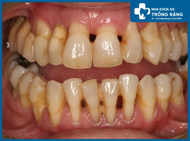 Viem nha chu tuột nướu