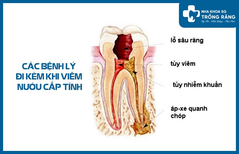 Viêm nướu cấp tính