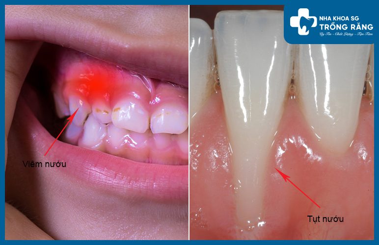 Viêm nướu cũng làm răng đau nhức