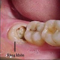 mọc răng khôn mô phỏng