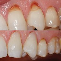 mòn cổ chân răng mô phỏng