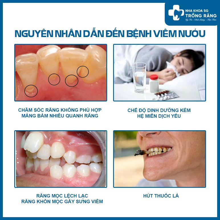 nguyen nhan gay viem nuou nguyên nhân gây viêm nướu
