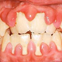 viêm nướu tụt lợi mô phỏng