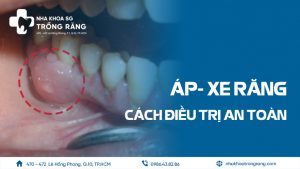 Áp Xe Răng