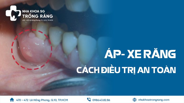 Áp Xe Răng