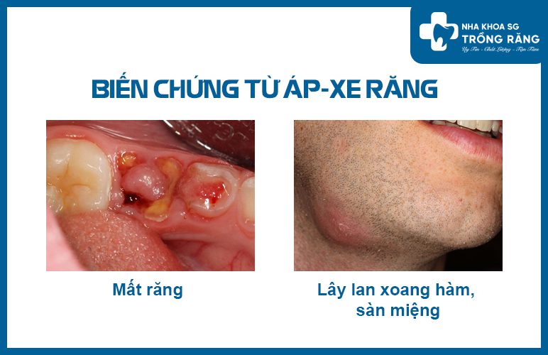 Biến chứng áp xe răng