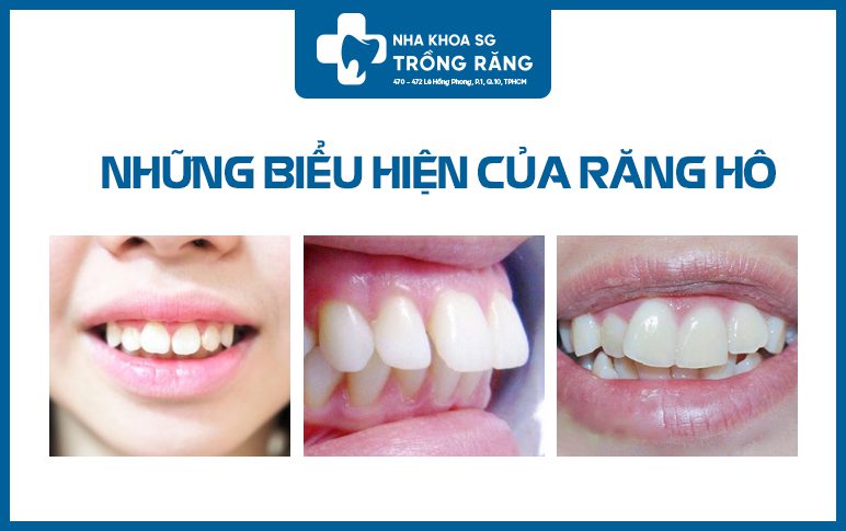 Biểu hiện đang bị răng hô