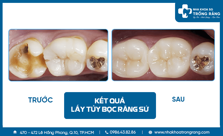 Bọc sứ răng hàm bị sâu lỗ to