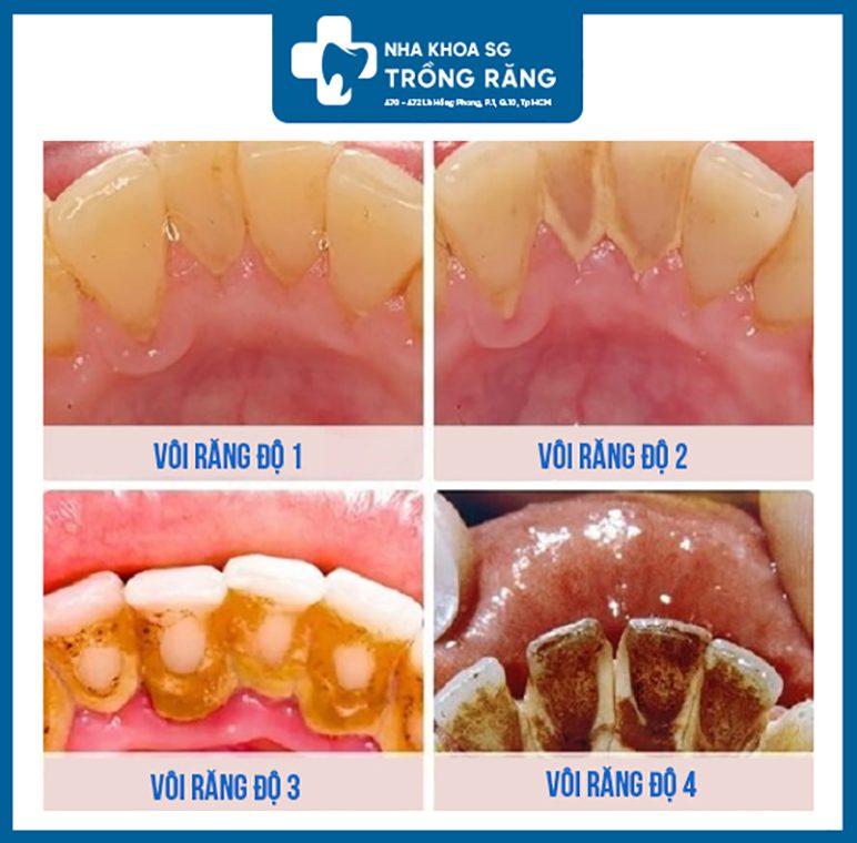 Các cấp độ vôi răng Các cấp độ vôi răng