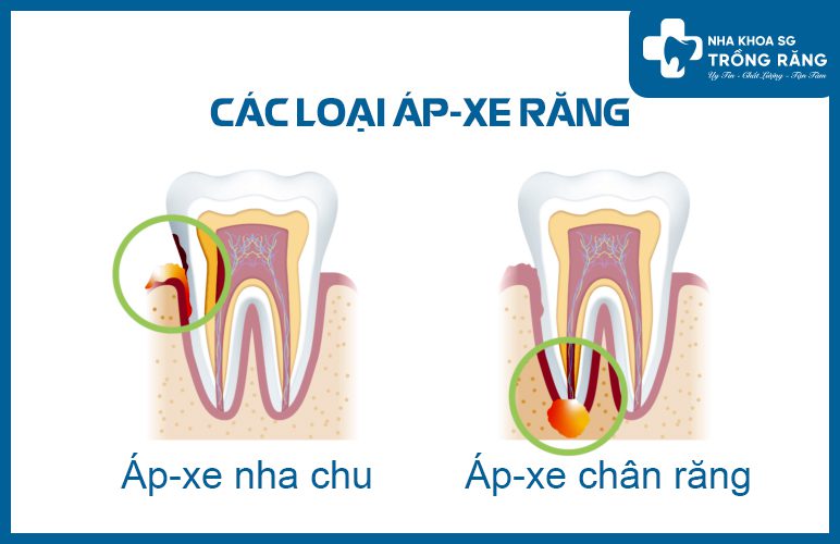 Các loại áp xe răng