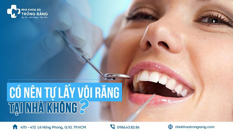 Có nên tự lấy vôi răng tại nhà