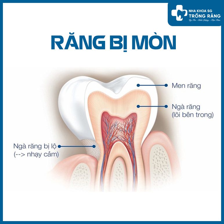 Nguyên nhân ê buốt răng